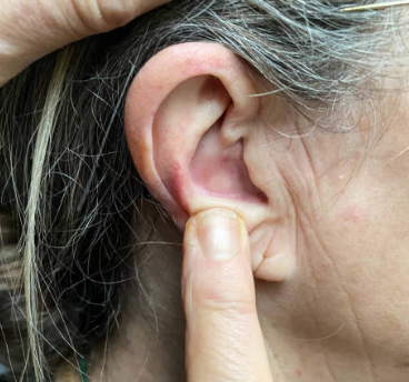ear pimple