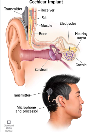 cochlear-implant-surgery