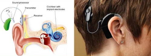 cochlear implant surgery