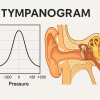  What is a Tympanogram? Understanding Tympanometry and the Different Tympanogram Types